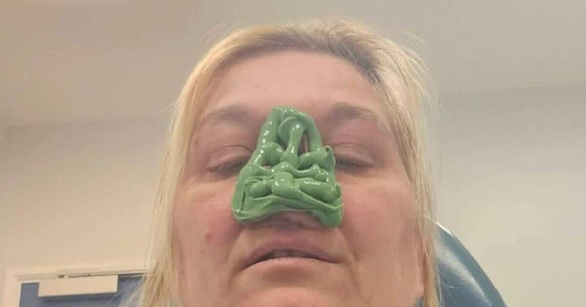 'I thought my nosebleeds were hay fever but then the doctors amputated my nose'